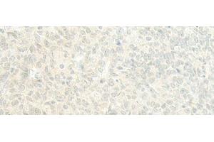 Immunohistochemistry of paraffin-embedded Human ovarian cancer tissue using ESRP2 Polyclonal Antibody at dilution of 1:95(x200) (ESRP2 antibody)
