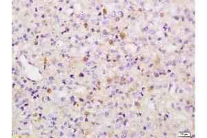 Formalin-fixed and paraffin embedded human brain glioma tissue labeled with Anti-Phospho-Wee1(Ser642) Polyclonal Antibody, Unconjugated  at 1:200 followed by conjugation to the secondary antibody and DAB staining (WEE1 antibody  (pSer642))