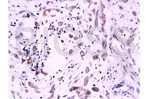Formalin-fixed and paraffin embedded human colon carcinoma labeled Anti-B7H4 Polyclonal Antibody, Unconjugated (ABIN671736) at 1:200, followed by conjugation to the secondary antibody and DAB staining