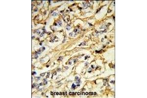 Formalin-fixed and paraffin-embedded human breast carcinoma reacted with CHB Antibody (N-term), which was peroxidase-conjugated to the secondary antibody, followed by DAB staining. (CHMP4B antibody  (N-Term))