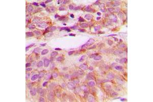 Immunohistochemical analysis of c-SRC (pY529) staining in human breast cancer formalin fixed paraffin embedded tissue section.