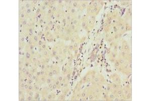 Immunohistochemistry of paraffin-embedded human liver cancer using ABIN7160913 at dilution of 1:100 (NDUFA9 antibody  (AA 1-270))