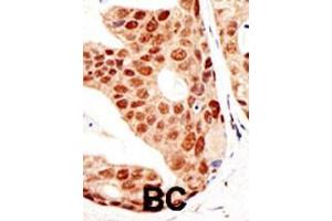 Formalin-fixed and paraffin-embedded human cancer tissue reacted with the primary antibody, which was peroxidase-conjugated to the secondary antibody, followed by DAB staining. (PIAS3 antibody  (N-Term))