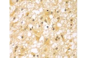 Immunohistochemistry of paraffin-embedded Human brain cancer using PAK6 Polyclonal Antibody at dilution of 1:100 (40x lens). (PAK6 antibody)