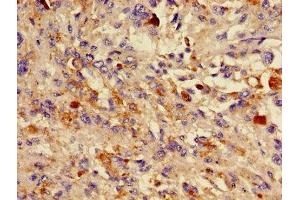 Immunohistochemistry of paraffin-embedded human melanoma using ABIN7157786 at dilution of 1:100 (DCT antibody  (AA 44-205))