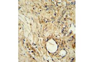 Immunohistochemistry analysis in formalin fixed and paraffin embedded human breast carcinoma reacted with AP52256PU-N, which was peroxidase conjugated to the secondary antibody and followed by DAB staining. (ITIH5 antibody  (C-Term))