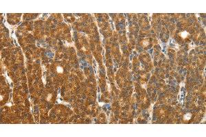 Immunohistochemistry of paraffin-embedded Human thyroid cancer using PTCH1 Polyclonal Antibody at dilution of 1:50 (Patched 1 antibody)
