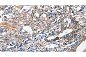 Immunohistochemistry of paraffin-embedded Human gastric cancer using AKR1D1 Polyclonal Antibody at dilution of 1:35 (AKR1D1 antibody)