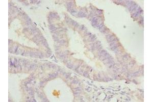 Immunohistochemistry of paraffin-embedded human endometrial cancer using ABIN7157970 at dilution of 1: 100