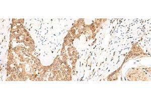 Immunohistochemistry of paraffin-embedded Human esophagus cancer tissue using PPP1R3C Polyclonal Antibody at dilution of 1:50(x200) (PPP1R3C antibody)