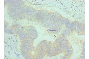 Immunohistochemistry of paraffin-embedded human colon cancer using ABIN7144372 at dilution of 1:100 (AP2M1 antibody  (AA 136-435))