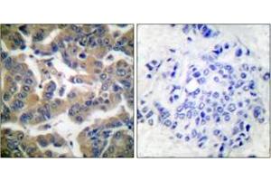 Immunohistochemistry analysis of paraffin-embedded human breast carcinoma, using GR (Phospho-Ser211) Antibody. (GR (AA 181-230), (pSer211) antibody)