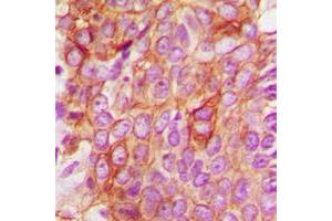 Immunohistochemical analysis of BAX staining in human breast cancer formalin fixed paraffin embedded tissue section. (BAX antibody  (Center))