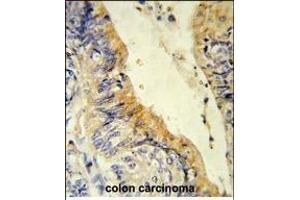 Formalin-fixed and paraffin-embedded human colon carcinoma reacted with ACADM Antibody (Center), which was peroxidase-conjugated to the secondary antibody, followed by DAB staining. (Medium-Chain Specific Acyl-CoA Dehydrogenase, Mitochondrial (MCAD) (AA 189-217) antibody)