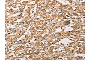 The image on the left is immunohistochemistry of paraffin-embedded Human thyroid cancer tissue using ABIN7131608(WNT11 Antibody) at dilution 1/20, on the right is treated with fusion protein. (WNT11 antibody)