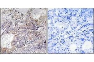 Immunohistochemistry analysis of paraffin-embedded human breast carcinoma tissue, using BAD (Ab-155) Antibody. (BAD antibody  (AA 119-168))