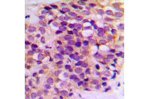 Immunohistochemical analysis of BCL2 staining in human breast cancer formalin fixed paraffin embedded tissue section. (Bcl-2 antibody  (Center))
