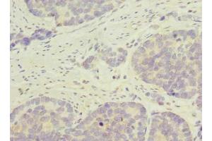 Immunohistochemistry of paraffin-embedded human gastric cancer using ABIN7145326 at dilution of 1:100 (C9orf89 antibody  (AA 1-183))