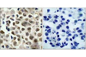 Immunohistochemical analysis of paraffin-embedded human lung carcinoma tissue, using HDAC8 (phospho-Ser39) antibody (E011128). (HDAC8 antibody  (pSer39))