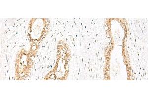 Immunohistochemistry of paraffin-embedded Human breast cancer tissue using JPT1 Polyclonal Antibody at dilution of 1:35(x200) (JPT1 antibody)