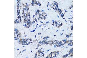 Immunohistochemistry of paraffin-embedded human breast cancer using HDAC5 antibody (ABIN6290464) at dilution of 1:100 (40x lens). (HDAC5 antibody)