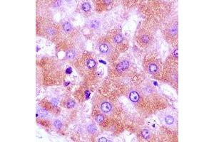 Immunohistochemical analysis of GNA11 staining in human liver cancer formalin fixed paraffin embedded tissue section. (GNA11 antibody)