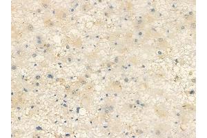 ABIN6257844 and ABIN6274385 at 1/100 staining human astrocytoma by IHC-P.