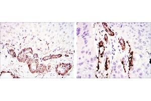 Immunohistochemical analysis of paraffin-embedded liver tissues (left) and lung cancer tissues (right) using ACTA2 mouse mAb with DAB staining. (Smooth Muscle Actin antibody)