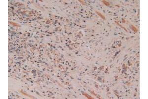 IHC-P analysis of Human Prostate Gland Cancer Tissue, with DAB staining. (Cytochrome C antibody  (AA 5-100))