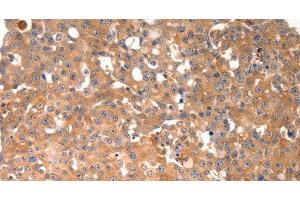Immunohistochemistry of paraffin-embedded Human breast cancer tissue using BGLAP Polyclonal Antibody at dilution of 1:40 (Osteocalcin antibody)