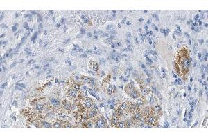ABIN6274385 at 1/100 staining Human liver cancer tissue by IHC-P.