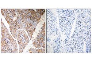 Immunohistochemistry analysis of paraffin-embedded human liver carcinoma tissue, using BAG3 antibody. (BAG3 antibody  (Internal Region))