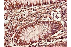 Immunohistochemistry of paraffin-embedded human colon cancer using ABIN7149396 at dilution of 1:100 (CIAO3 (AA 2-265) antibody)