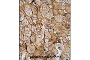 Formalin-fixed and paraffin-embedded human prostata carcinoma tissue reacted with CK1G (Center ) (ABIN391377 and ABIN2841388) , which was peroxidase-conjugated to the secondary antibody, followed by DAB staining. (CAMK1G antibody  (AA 211-241))