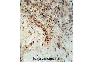 DCLRE1C Antibody (N-term) (ABIN653693 and ABIN2843013) immunohistochemistry analysis in formalin fixed and paraffin embedded human lung carcinoma followed by peroxidase conjugation of the secondary antibody and DAB staining.