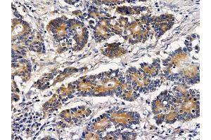 ABIN6257712 and ABIN6273523 at 1/100 staining human colorectal cancer by IHC-P. (IFRD1 antibody  (N-Term))