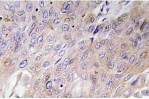 Immunohistochemistry (IHC) analyzes of BMP-3 antibody in paraffin-embedded human lung carcinoma tissue. (BMP3 antibody)