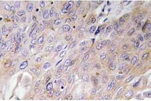 Immunohistochemistry (IHC) analyzes of BMP-3 antibody in paraffin-embedded human lung carcinoma tissue.