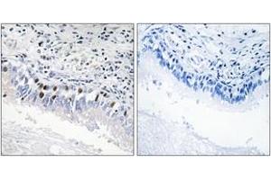 Immunohistochemistry analysis of paraffin-embedded human lung carcinoma, using MED12 Antibody. (MED12 antibody  (AA 611-660))