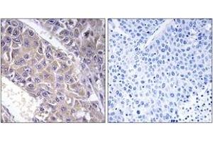 Immunohistochemistry analysis of paraffin-embedded human liver carcinoma tissue, using B4GALT3 Antibody. (B4GALT3 antibody  (AA 271-320))