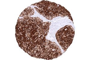 Squamous cell carcinoma of the skin with strong CK17 staining of all tumor cells (Recombinant KRT17 antibody)