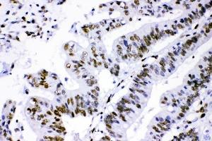 IHC analysis of PML using anti-PML antibody (ABIN4886699). (PML antibody  (N-Term))