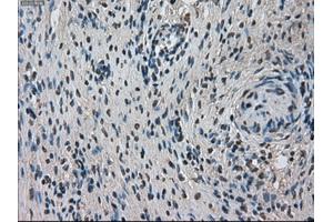 Immunohistochemical staining of paraffin-embedded Adenocarcinoma of breast tissue using anti-TMEM100 mouse monoclonal antibody. (TMEM100 antibody)