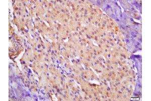 Formalin-fixed and paraffin embedded human laryngocarcinoma labeled with Anti-CTDSP2 Polyclonal Antibody, Unconjugated  at 1:200 followed by conjugation to the secondary antibody and DAB staining. (CTDSP2 antibody  (AA 25-150))