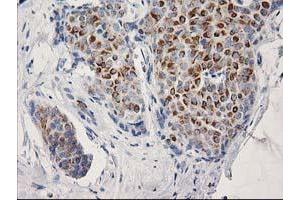 Immunohistochemical staining of paraffin-embedded Adenocarcinoma of Human breast tissue using anti-OSGEP mouse monoclonal antibody. (OSGEP antibody  (AA 1-335))