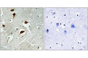 Immunohistochemistry analysis of paraffin-embedded human brain carcinoma, using 4E-BP1 (Phospho-Thr69) Antibody. (eIF4EBP1 antibody  (pThr69))