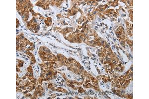 Immunohistochemistry of Human lung cancer using SPAG1 Polyclonal Antibody at dilution of 1:25 (SPAG1 antibody)