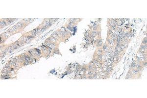 Immunohistochemistry of paraffin-embedded Human colorectal cancer tissue using FGF10 Polyclonal Antibody at dilution of 1:30(x200) (FGF10 antibody)