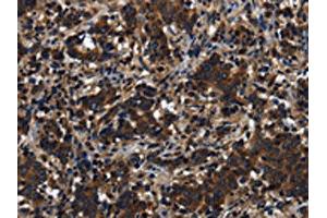 The image on the left is immunohistochemistry of paraffin-embedded Human liver cancer tissue using ABIN7191225(KLHL8 Antibody) at dilution 1/20, on the right is treated with synthetic peptide. (KLHL8 antibody)