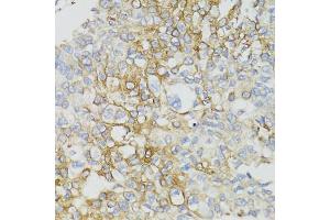 Immunohistochemistry of paraffin-embedded human prostate cancer using ND5 antibody (ABIN5975833) at dilution of 1/100 (40x lens). (MT-ND5 antibody)